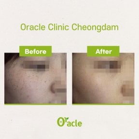 Résultats Thermage avant et après à Oracle Clinic Cheongdam, texture de peau améliorée