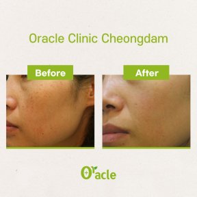 Before and after IPL skin treatment results at Oracle Clinic Cheongdam, improved skin tone