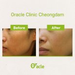 Before and after IPL skin treatment results at Oracle Clinic Cheongdam, improved skin tone