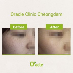 Vorher-nachher-Ergebnis IPL-Hautbehandlung bei Oracle Clinic Cheongdam, verbesserter Hautton