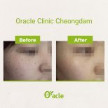 Vorher-nachher-Ergebnis IPL-Hautbehandlung bei Oracle Clinic Cheongdam, verbesserter Hautton