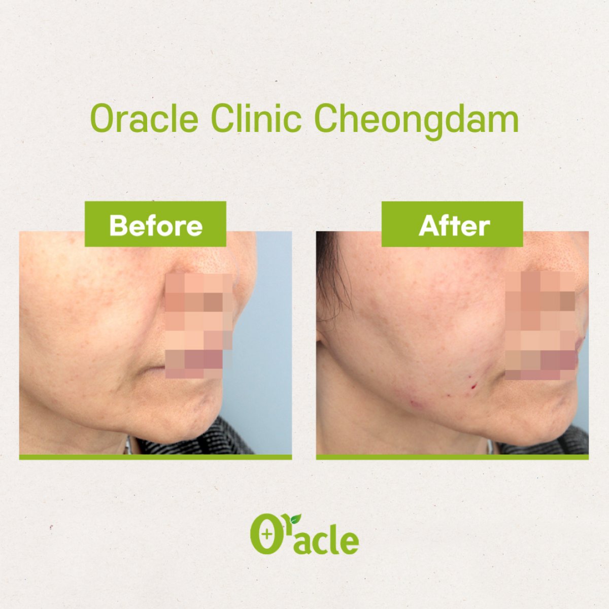 نتائج شد الوجه بالخيوط قبل وبعد في Oracle Clinic Cheongdam، رفع واضح لملامح الوجه