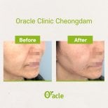 Результати до і після ниткового ліфтингу в Oracle Clinic Cheongdam, помітний ліфтинг обличчя