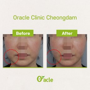Before and after threads lifting result at Oracle Clinic Cheongdam, facial contour improvement