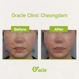 Before and after threads lifting result at Oracle Clinic Cheongdam, facial contour improvement
