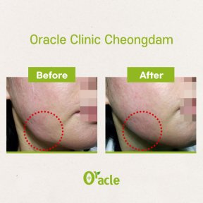 Efekty liftingu nićmi przed i po w Oracle Clinic Cheongdam, poprawiony kontur żuchwy