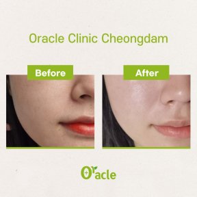 Efekt przed i po liftingu nićmi w Oracle Clinic Cheongdam, poprawa konturu twarzy