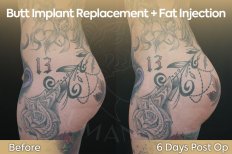 Resultados antes y después de reemplazo de implante de glúteos con grasa en Dr. Safa Manav