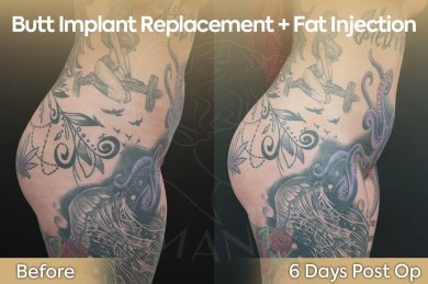 Resultados antes y después de reemplazo de implantes de glúteos con grasa en Dr. Safa Manav