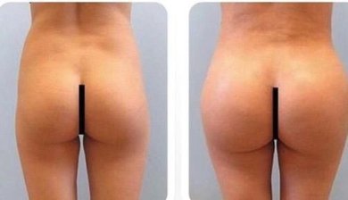 Antes y después de implantes de glúteos en Dr. Safa Manav Clinic – contorno mejorado