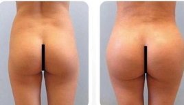 Antes y después de implantes de glúteos en Dr. Safa Manav Clinic – contorno mejorado