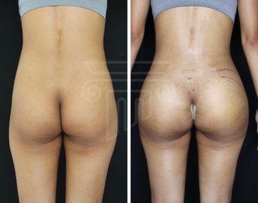 До и после ягодичных имплантов в клинике Dr. Safa Manav – улучшенный контур ягодиц