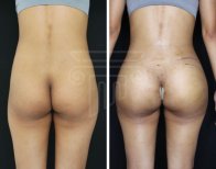 До и после ягодичных имплантов в клинике Dr. Safa Manav – улучшенный контур ягодиц