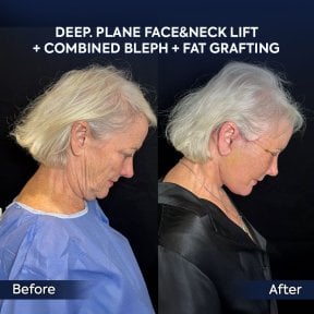 До і після підтяжки обличчя, шиї, блефаропластики та ліпофілінгу в клініці Dr. Safa Manav