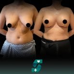 نتائج شد الثدي قبل وبعد في Soraca Med، تحسين شكل وتماسك الثدي