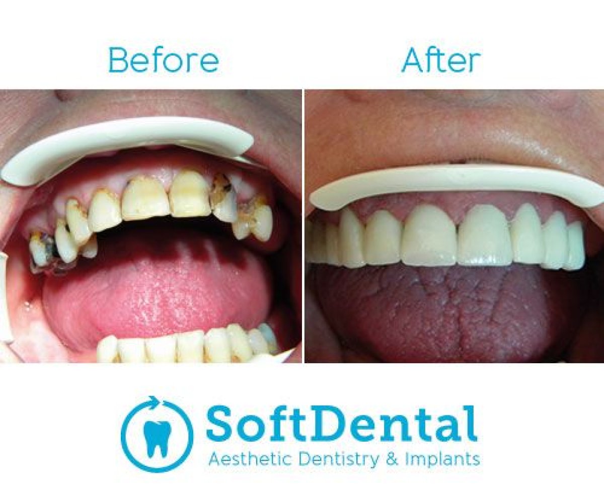 نتائج ترميم الأسنان قبل وبعد في SoftDentalCare Clinic – تحسين جمالية الابتسامة