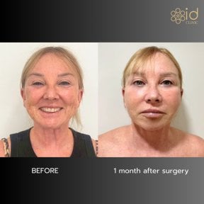 Before and after facial fat transfer results at ID Clinic Bangkok, 1 month post-surgery
