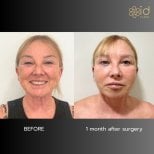 Before and after facial fat transfer results at ID Clinic Bangkok, 1 month post-surgery