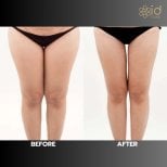 Before and after Vaser liposuction results at ID Clinic Bangkok, thigh contour improvement