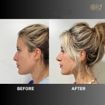 Before and after revision rhinoplasty result at ID Clinic Bangkok, improved nose profile
