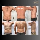 Before and after back lift results at ID Clinic Bangkok, visible body contour improvement