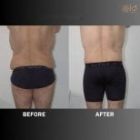 Before and after back lift results at ID Clinic Bangkok, improved back contour and firmness