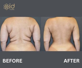 Before and after back lift results at ID Clinic Bangkok, improved back contour and skin tightening