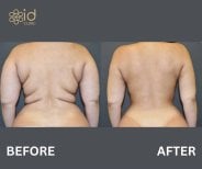 Before and after back lift results at ID Clinic Bangkok, improved back contour and skin tightening