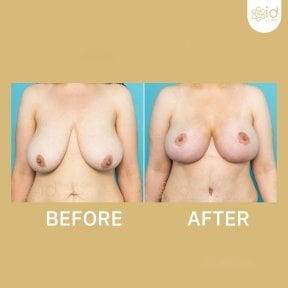 Before and after nipple reduction results at ID Clinic Bangkok, improved breast appearance