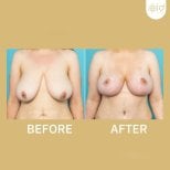 Before and after nipple reduction results at ID Clinic Bangkok, improved breast appearance