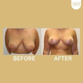 Before and after nipple reduction results at ID Clinic Bangkok, improved nipple appearance