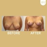 Before and after nipple reduction results at ID Clinic Bangkok, improved nipple appearance