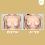 Before and after nipple reduction results at ID Clinic Bangkok, improved breast appearance