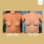 Before and after nipple reduction results at ID Clinic Bangkok, improved nipple appearance