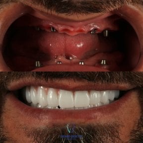 Before and after All-on-4 dental implants result at Grand Dental Hospital & Laboratory