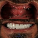 Before and after All-on-4 dental implants result at Grand Dental Hospital & Laboratory