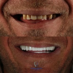 Before and after All-on-4 dental implants result at Grand Dental Hospital & Laboratory, smile restoration