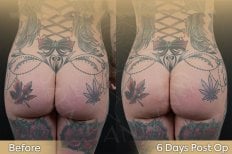 Результаты до и после ягодичных имплантов в клинике Dr. Safa Manav, улучшение формы