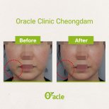 Vorher-nachher-Ergebnis Fadenlifting mit Hyaluronsäure bei Oracle Clinic Cheongdam