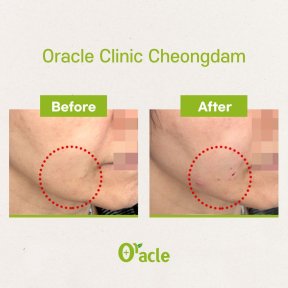 Vorher-nachher-Ergebnis Fadenlifting mit Hyaluronsäure an der Kieferlinie bei Oracle Clinic Cheongdam