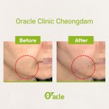 Vorher-nachher-Ergebnis Fadenlifting mit Hyaluronsäure an der Kieferlinie bei Oracle Clinic Cheongdam