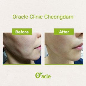 Vorher-nachher-Ergebnis Fadenlifting mit Hyaluronsäure bei Oracle Clinic Cheongdam, Gesichtskontur
