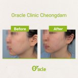 Vorher-nachher-Ergebnis Fadenlifting mit Hyaluronsäure bei Oracle Clinic Cheongdam, Gesichtskontur