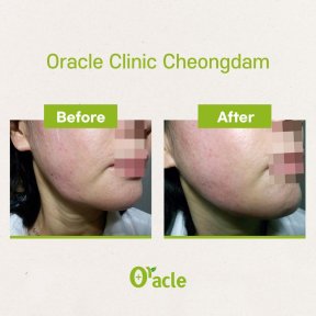 Vorher-nachher-Ergebnis Fadenlifting mit Hyaluronsäure bei Oracle Clinic Cheongdam