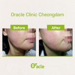 Vorher-nachher-Ergebnis Fadenlifting mit Hyaluronsäure bei Oracle Clinic Cheongdam