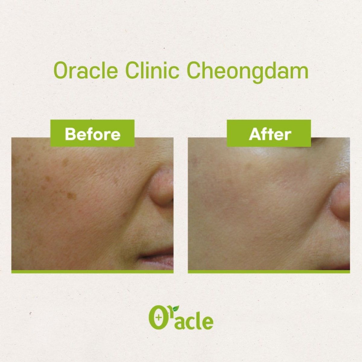 نتائج علاج الجلد IPL قبل وبعد في Oracle Clinic Cheongdam، تحسين لون البشرة