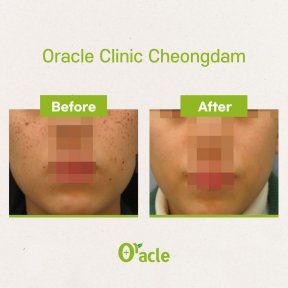 Vorher-nachher-Ergebnis IPL-Hautbehandlung bei Oracle Clinic Cheongdam, klarere Haut