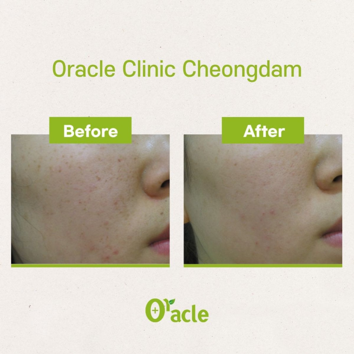 نتائج علاج البشرة IPL قبل وبعد في Oracle Clinic Cheongdam، وضوح بشرة محسّن
