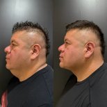 Результаты липосакции подбородка до и после в клинике Dr. Alexandro Aguilera - Plastic Surgery