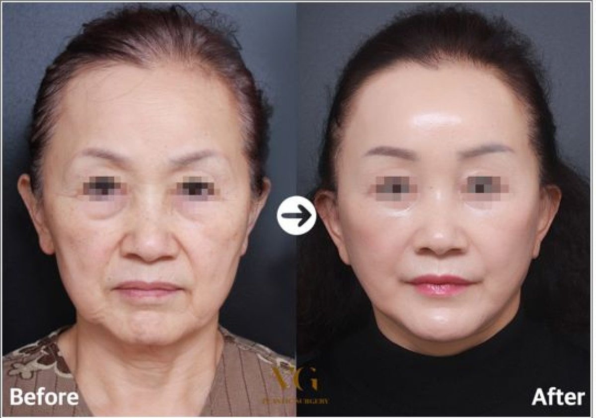 Resultados antes y después de lifting facial sin cirugía en VG Plastic Surgery, rejuvenecimiento facial